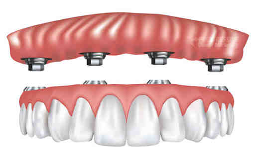 Can dental implants be done years after extraction?