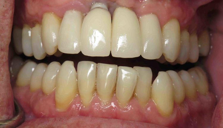 Can dental implants fail