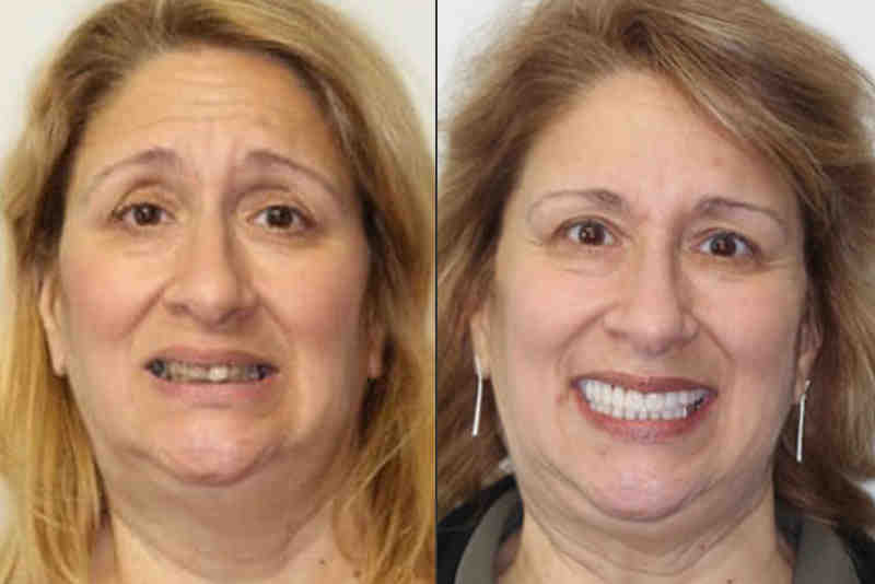 Can dental implants restore face shape?