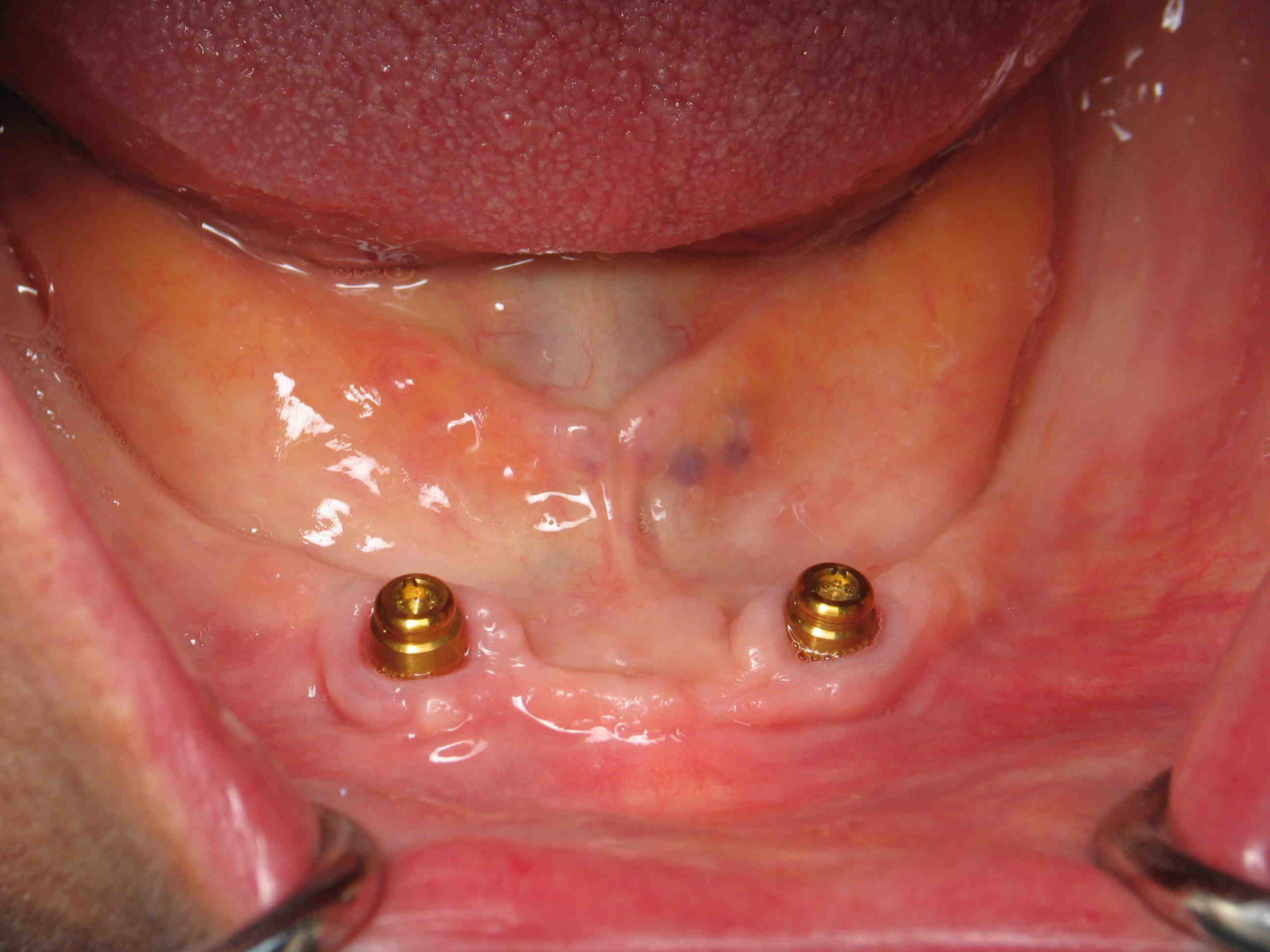 Can mini implants replace molars?