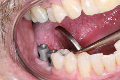 Can smokers teeth be fixed?