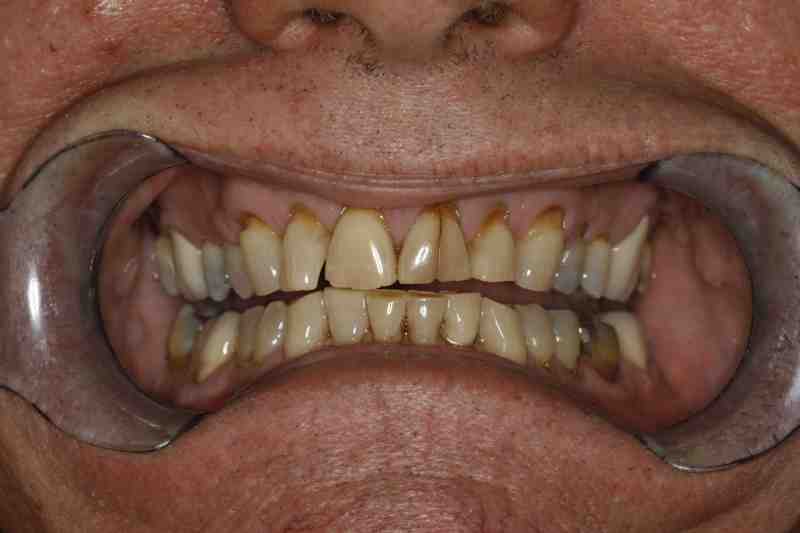 Can you break your teeth from grinding?