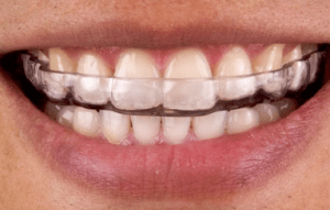 Can you break your teeth from grinding?