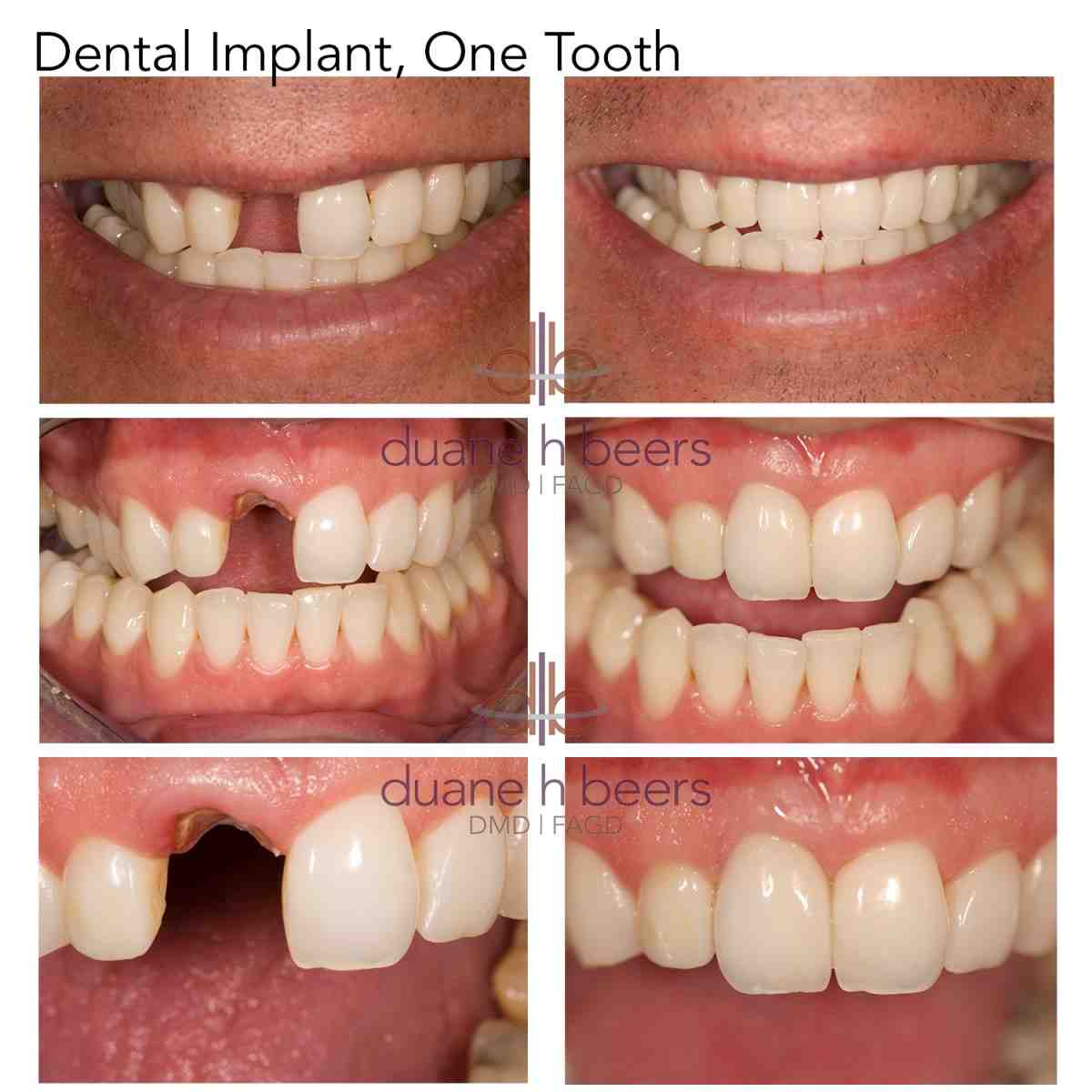 How much is a dental implant for one tooth Dental News Network