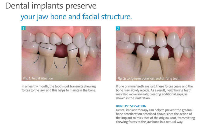 Can you get a dental implant if you have bone loss?