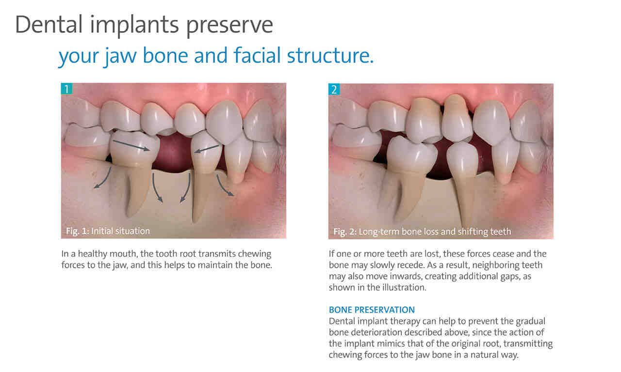 can-you-get-a-dental-implant-if-you-have-bone-loss-dental-news-network