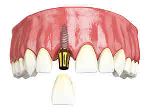 Can you get a single tooth implant?