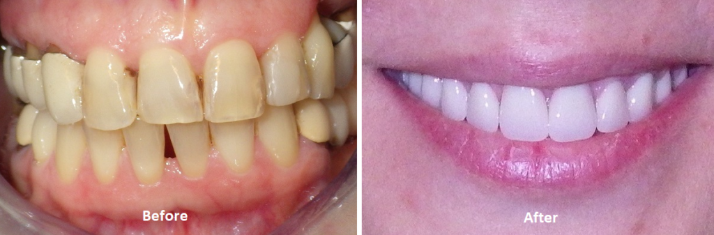 Can you get full dental implants in one day?