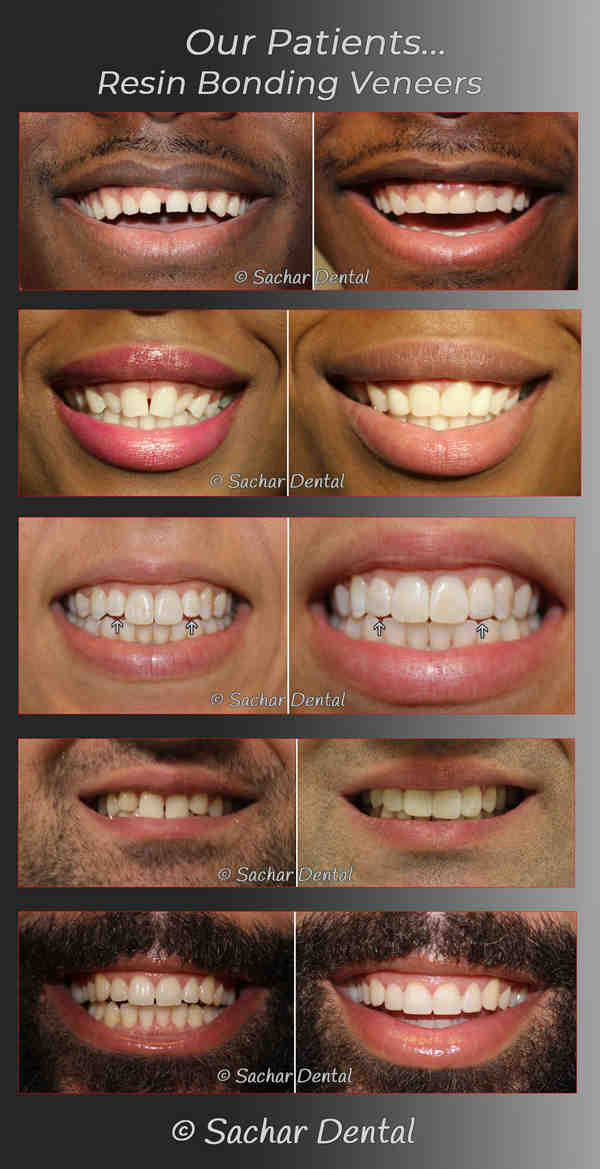 Can you get veneers with crooked teeth?