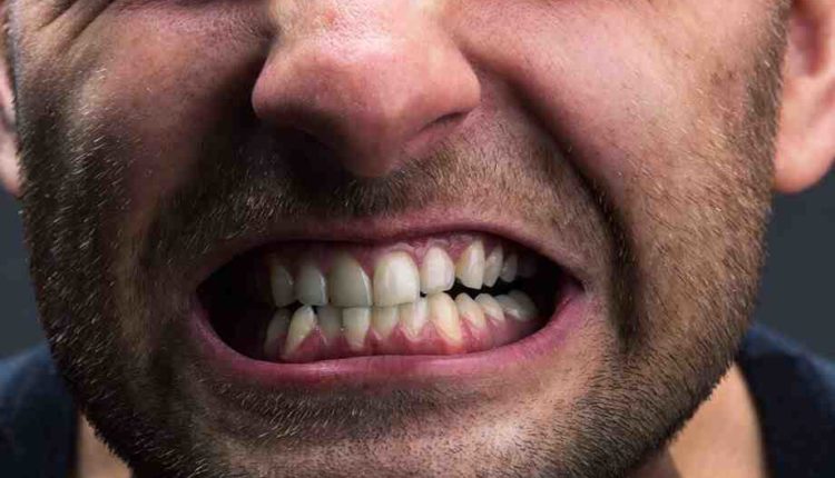 Can you have dental implants if you grind your teeth?