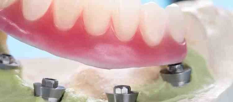 Can you have dental implants if you grind your teeth