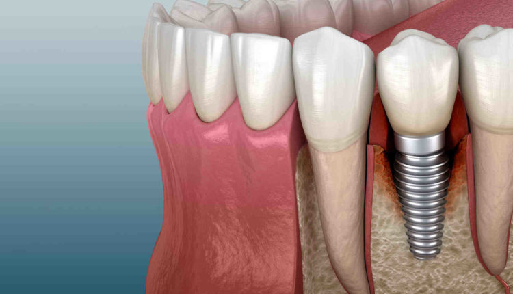 Can you sleep with dental implants