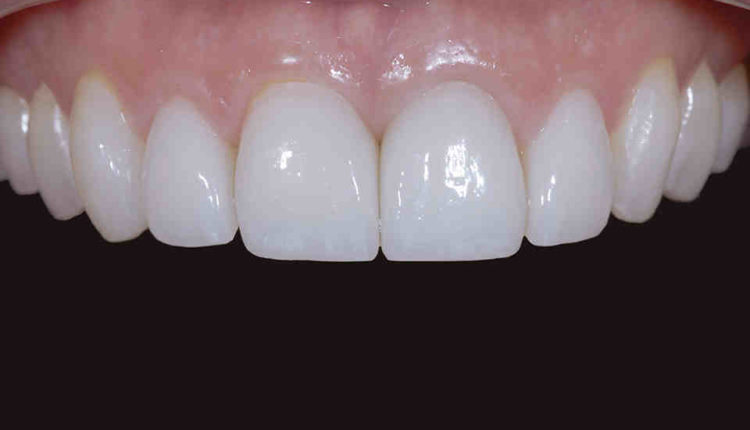 Cosmetic dentistry chicago crowns