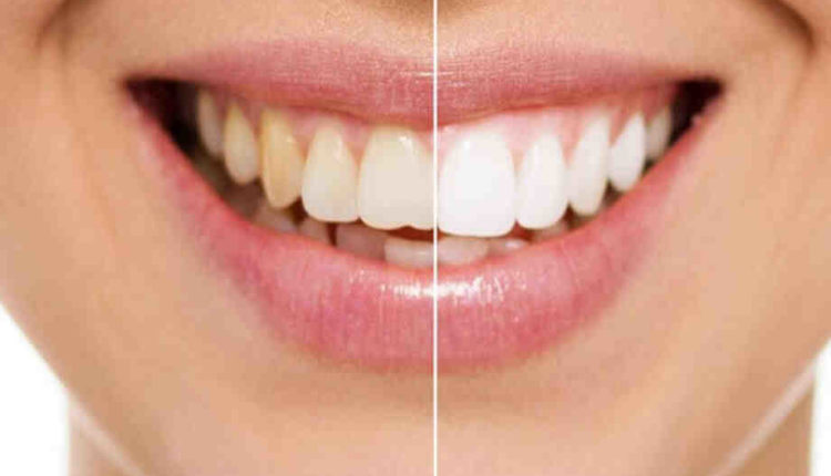 Cosmetic dentistry composite only