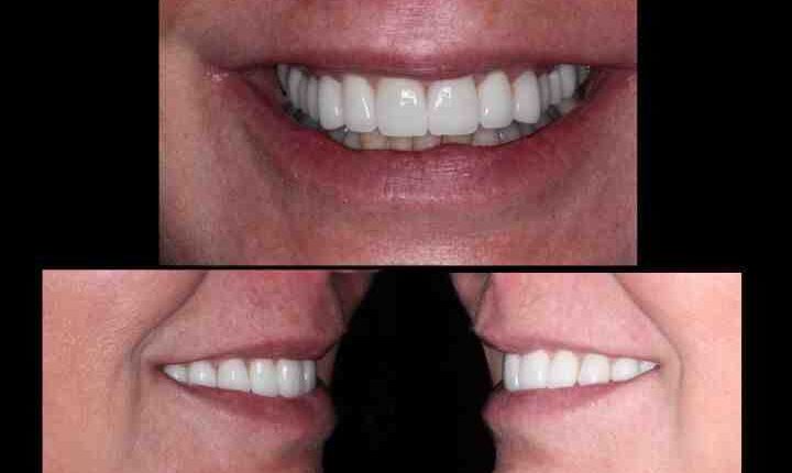 Cosmetic dentistry cost veneers