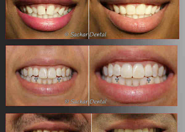 Cosmetic dentistry dental bonding
