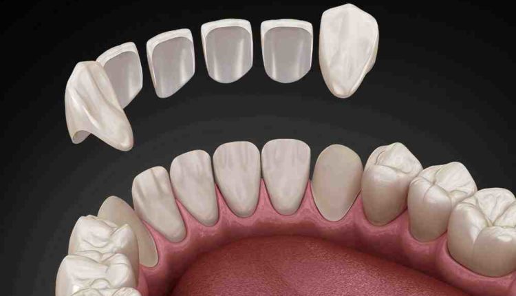 Cosmetic dentistry dental bonding detroit michigan