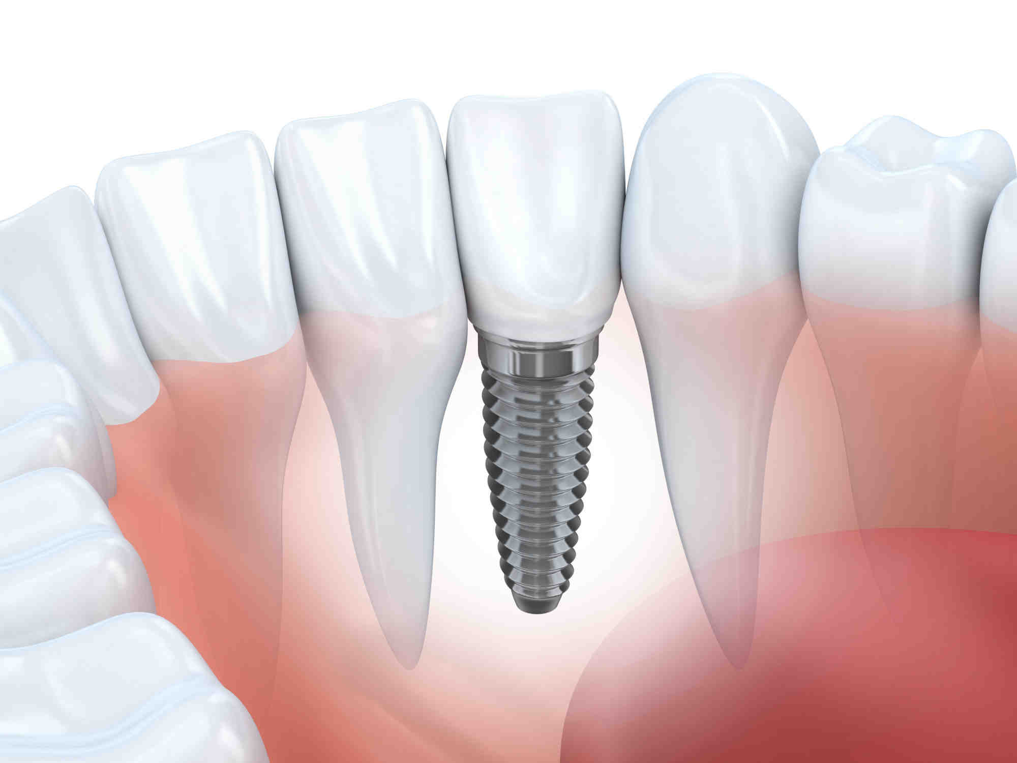 Do I really need a dental implant?