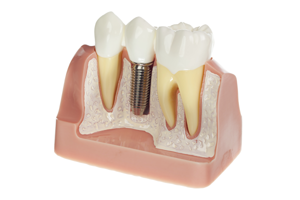 Do VA benefits cover dental implants?