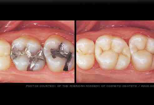 Do composite veneers ruin your teeth?