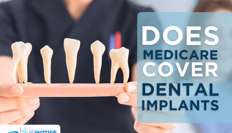 Do medicaid pay for dental implants?