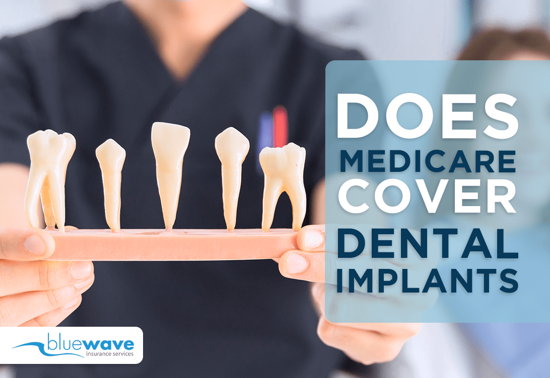 Do medicaid pay for dental implants? Dental News Network