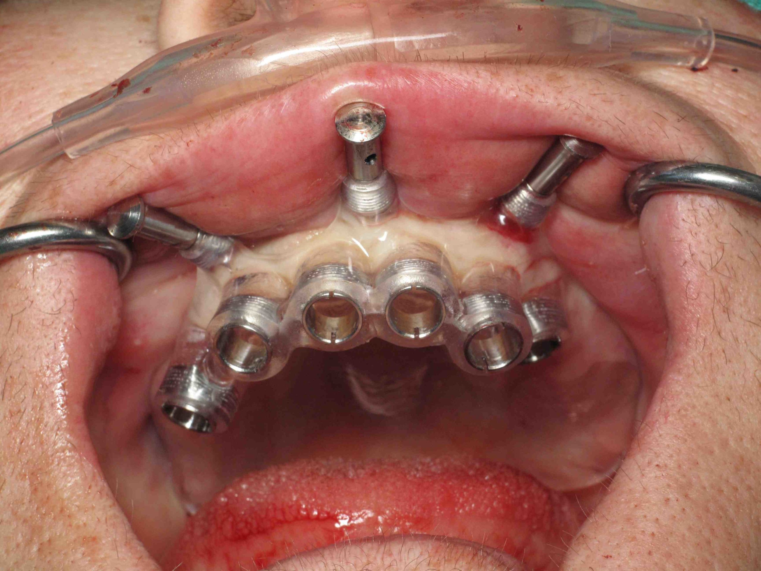 Do they put you to sleep for dental implants?