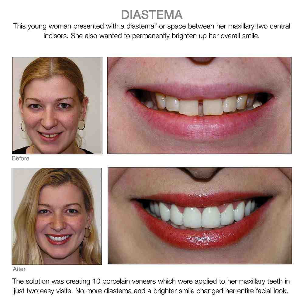 Do veneers make your lips look bigger?