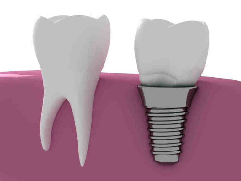 Is there dental insurance that covers implants Dental News Network