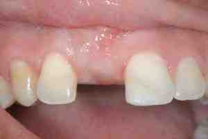 Does a dental implant abutment hurt?