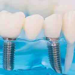 Does blue cross blue shield cover dental implants - Dental News Network