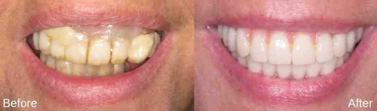 Does clear choice really do implants in one day?