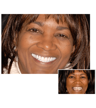 Does clear choice really do implants in one day?