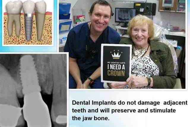 Does Metlife Dental Cover Implants For Adults