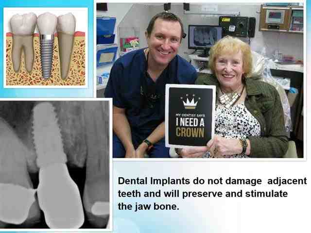 Does Metlife Cover Dental Implants Dental News Network