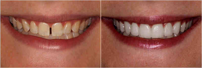 How Much Does a full dental makeover cost?