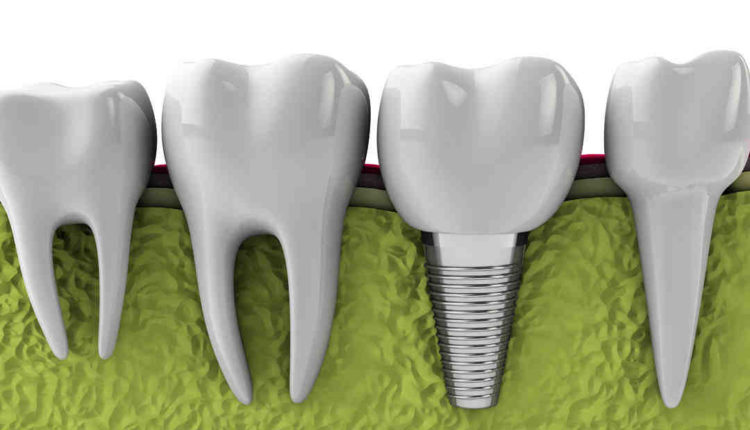 How are dental implants installed