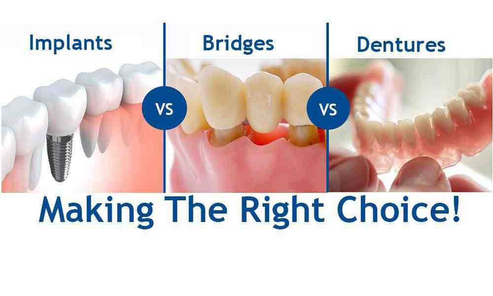 Does masshealth cover dental implants 2018 Dental News Network