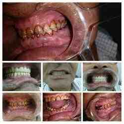 Does wellcare cover dental implants - Dental News Network