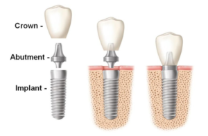 How can I get free dental implants?