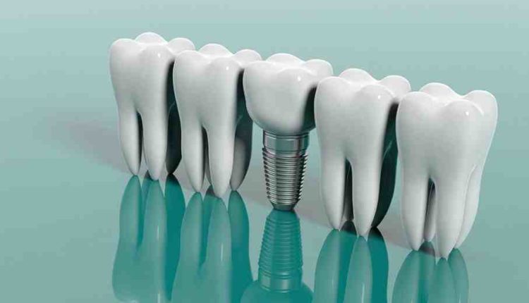 How can dental implants be done in one day