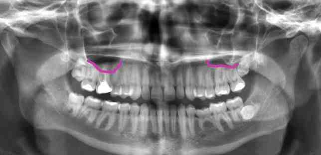 How do I know if my dental implant is infected?