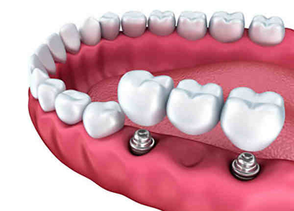 How do dental implants work with dentures