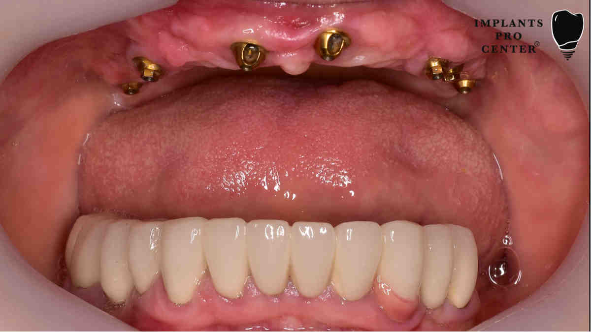 How do they put dental implants in?