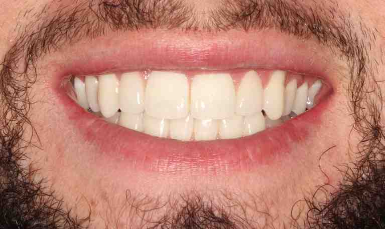 How do you become a dental veneer?