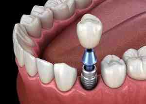 How does a dental implant work?