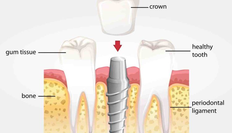How does a dental implant work