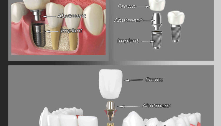 How is a crown attached to a dental implant - Dental News Network