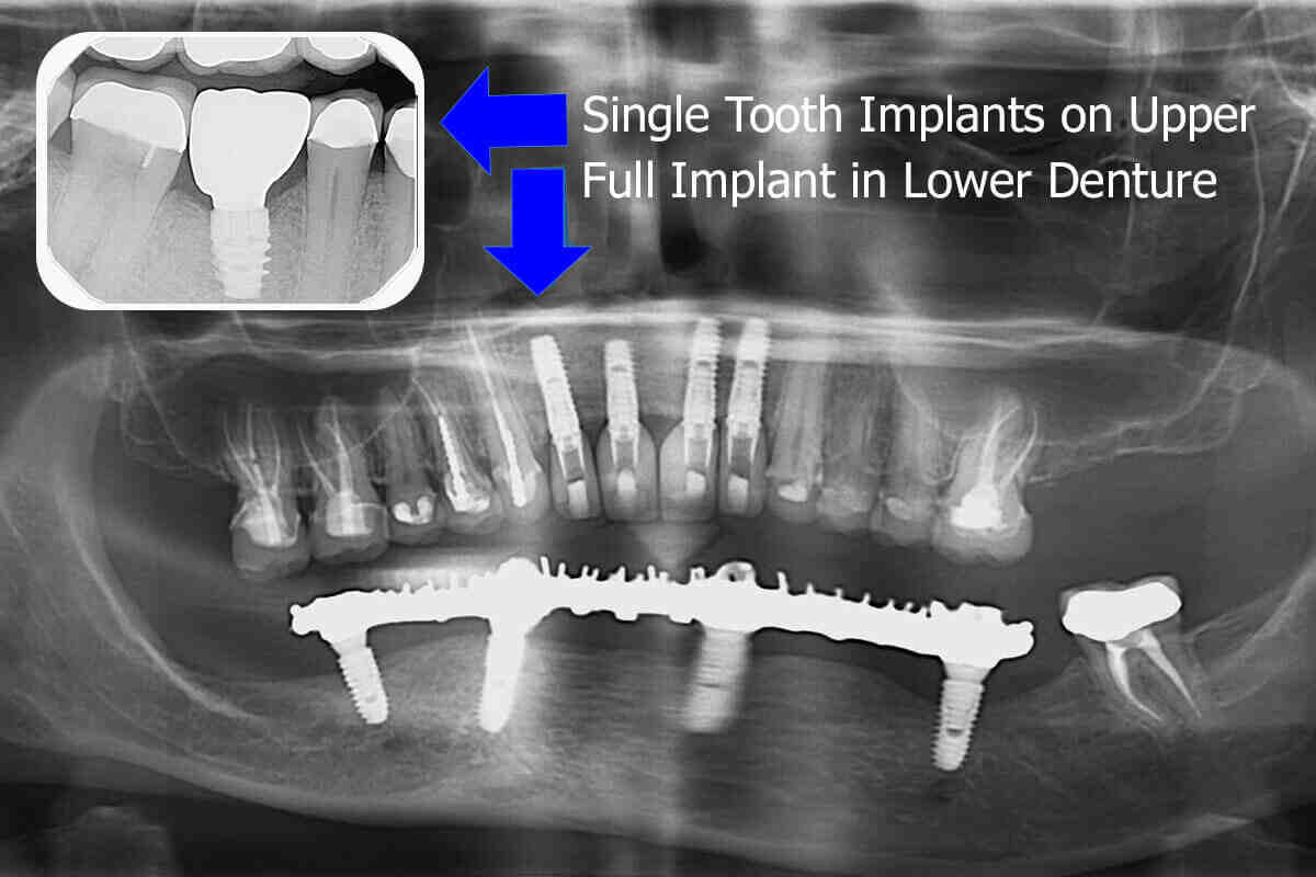 How is a tooth attached to an implant?