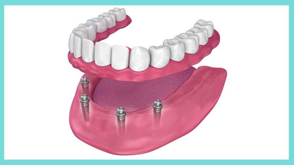 How long do all on 4 dental implants last?
